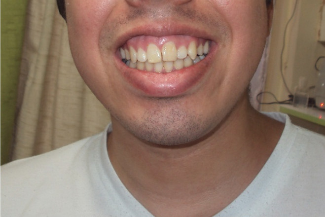 Resultado de rehabilitación oral