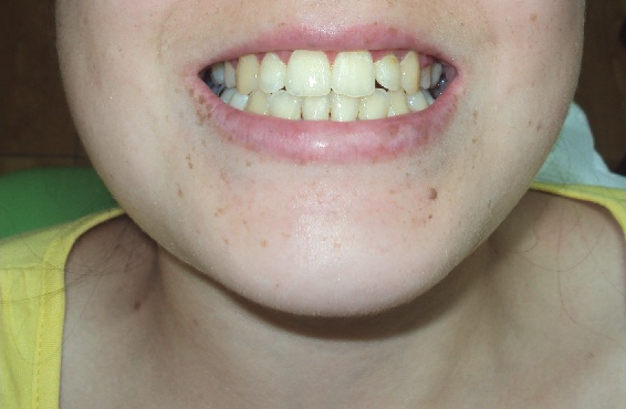 Resultado de rehabilitación oral